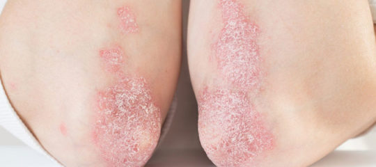 Le psoriasis